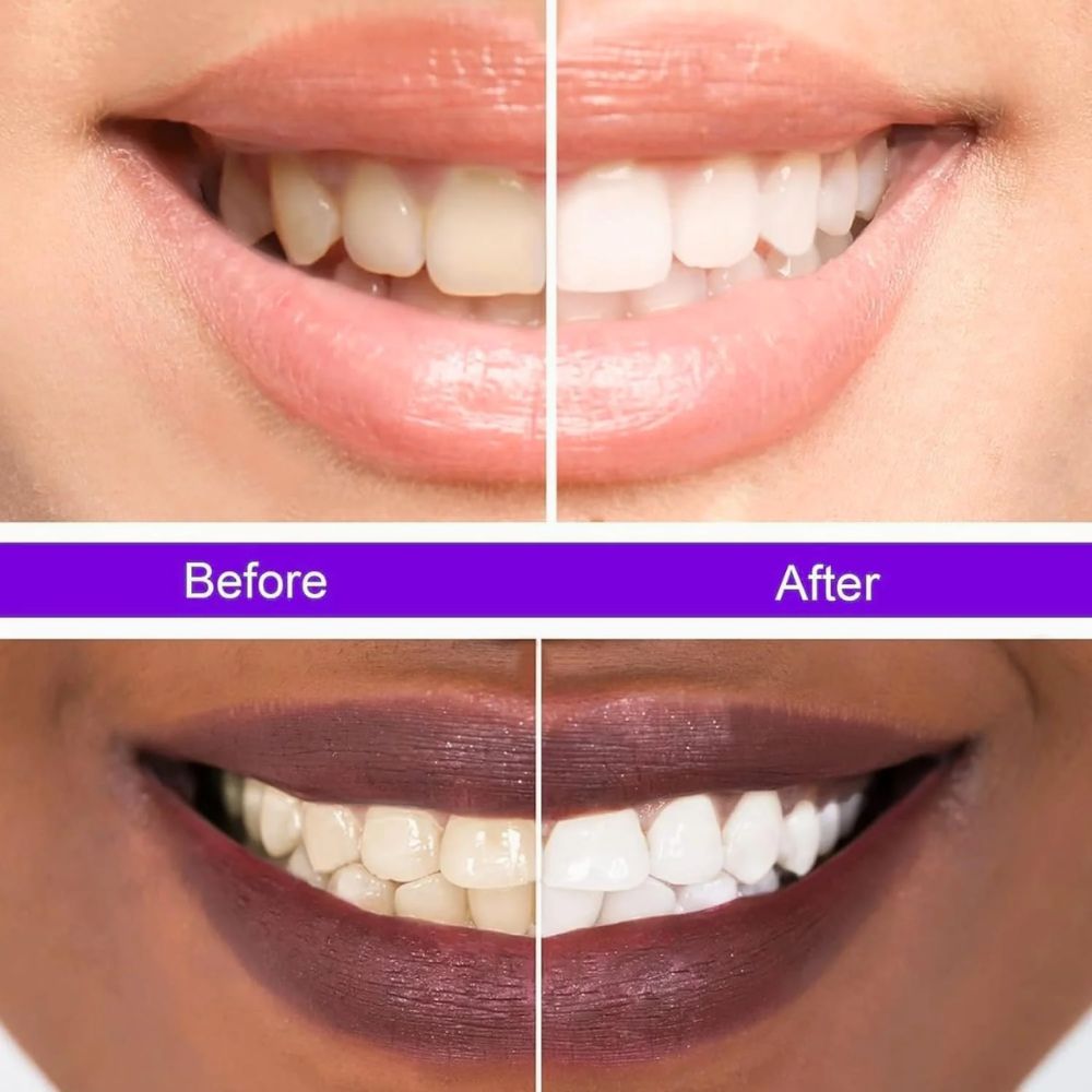 Hismile v34 , Tooth Stain Removal, Teeth Whitening Booster